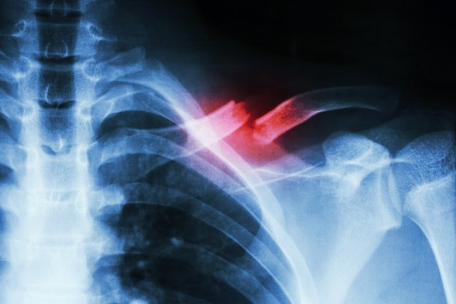 How To Identify Broken Collarbone Main Causes And Treatment